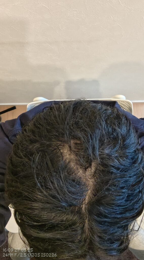 AGA治療開始2週間の髪の頭頂部の写真