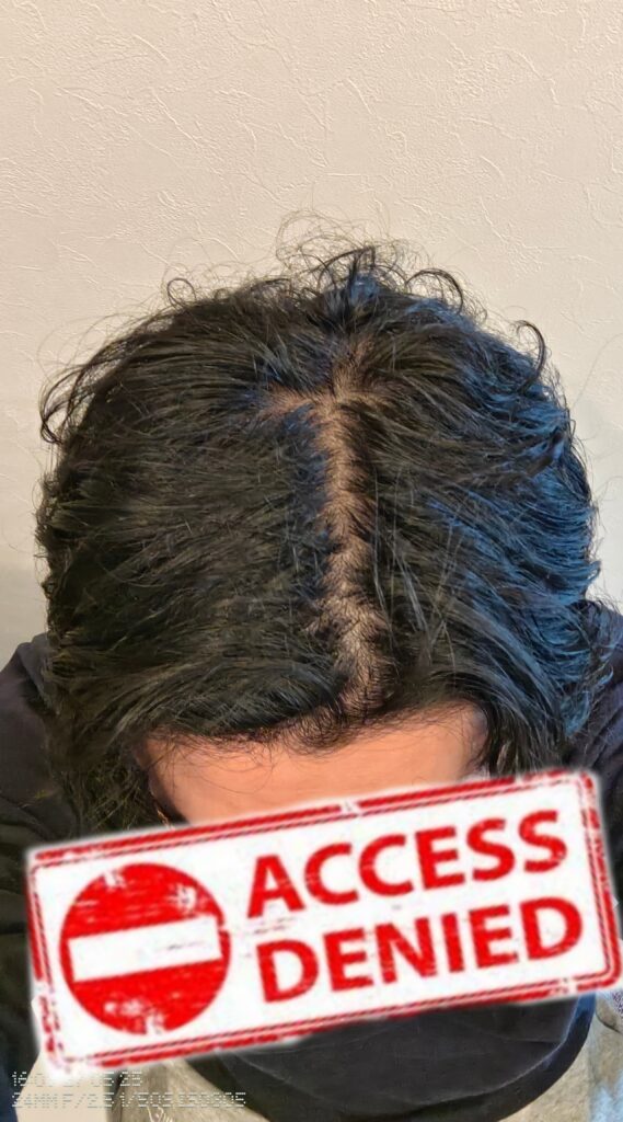 AGA治療開始2週間の髪の分け目の写真